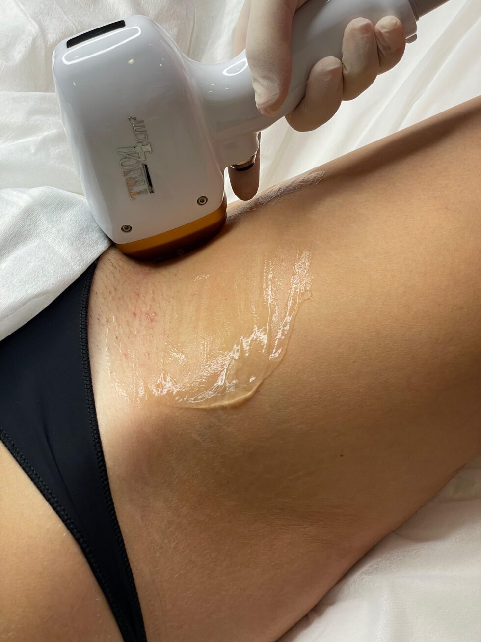 Detalj laserskog tretmana bikini područja