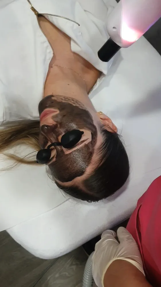 Pico Carbon Black tretman lica s ugljičnom maskom i zaštitom očiju